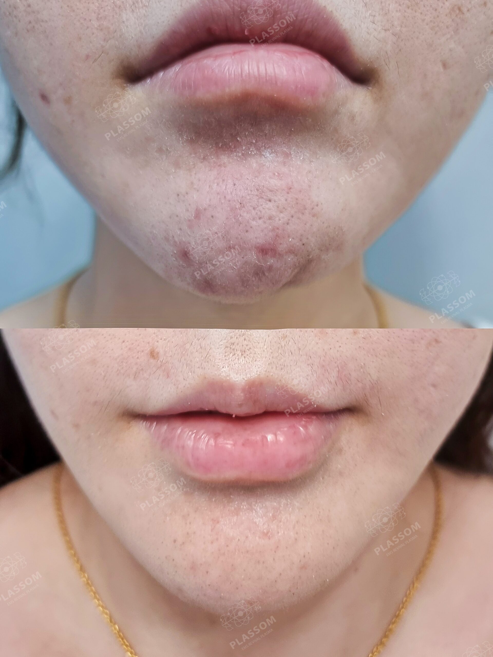 plassom acne ㅣ