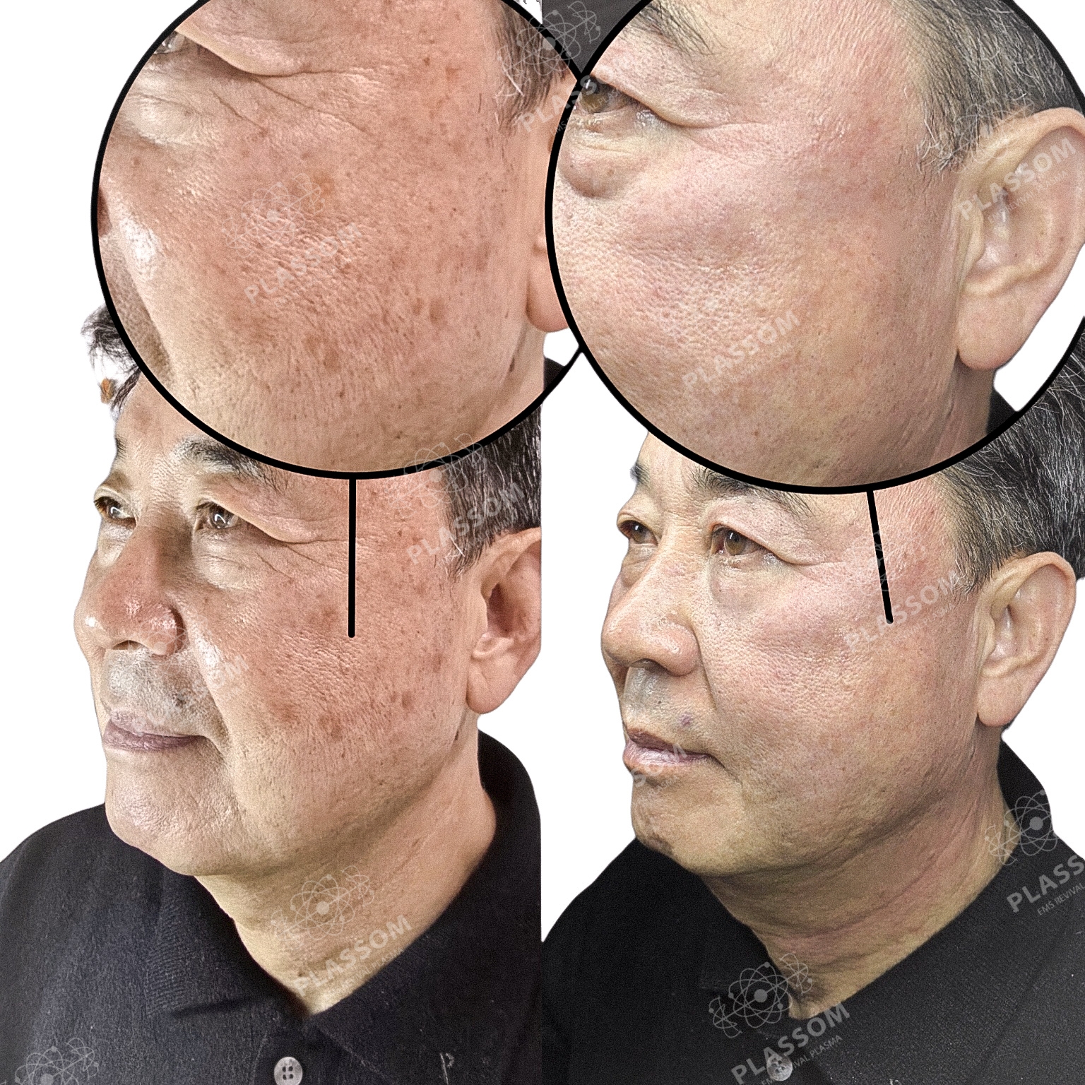 plassom 색소관리
