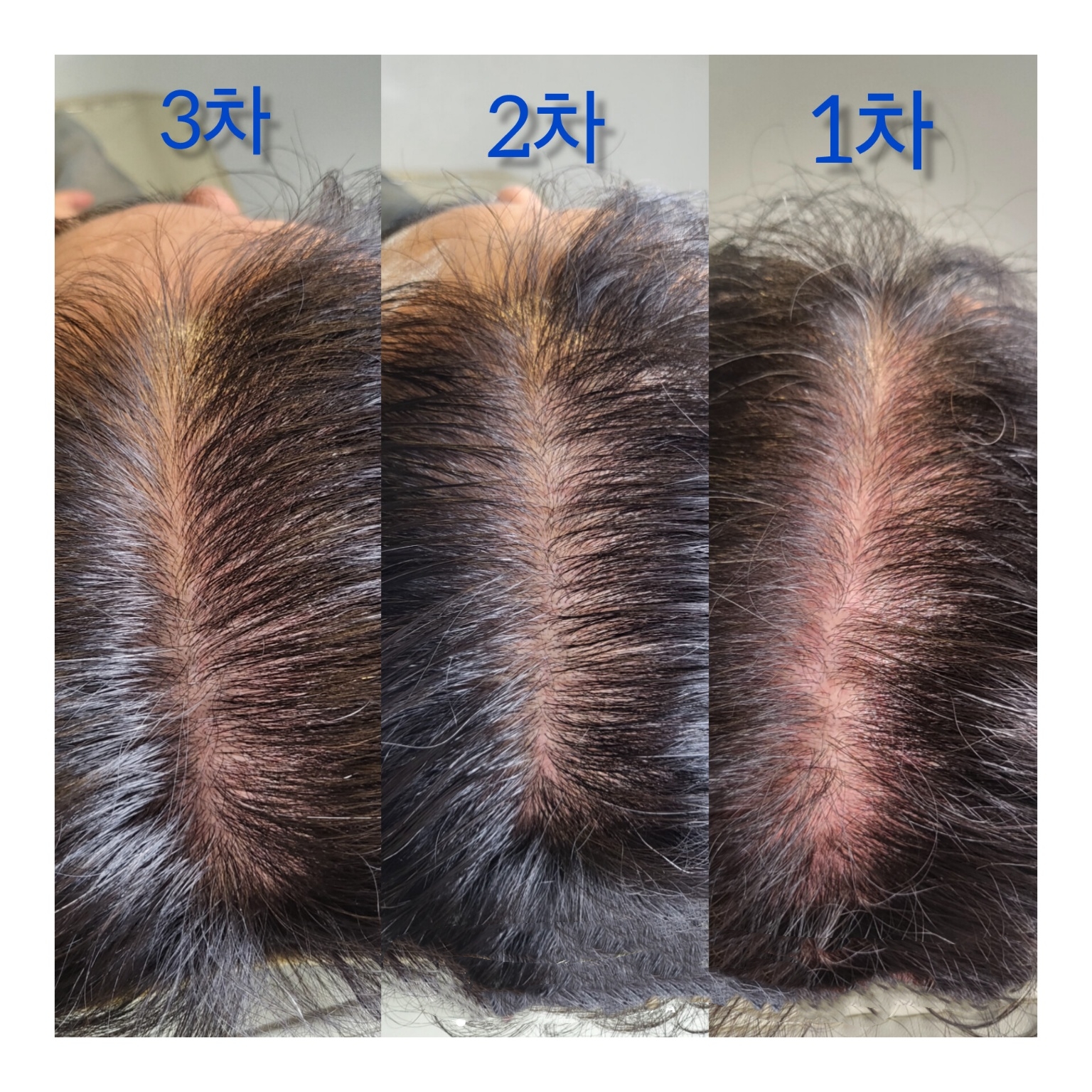 plassom scalp
